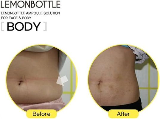 Lemon Bottle Solution Lipolysis utrata masy ciała 10 ml X 5 zmniejszenie tłuszczu Lemonbottle